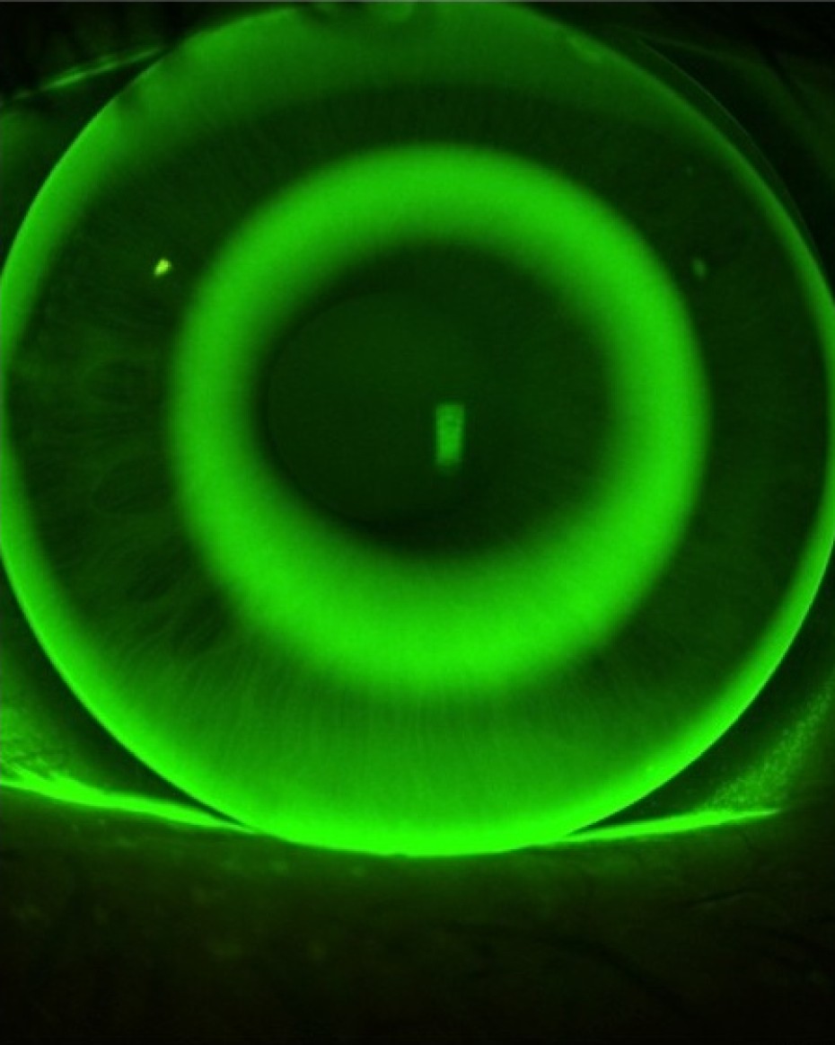 Darstellung eines Auges für Orthokeratologie